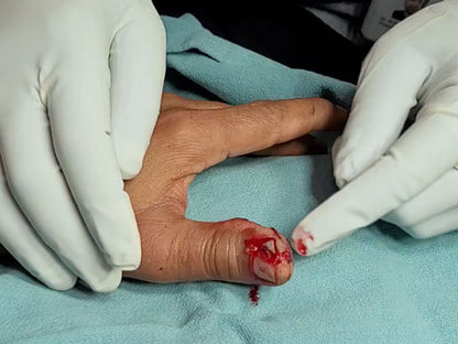 Sutured in Toronto, ON (June 28, 2025)
