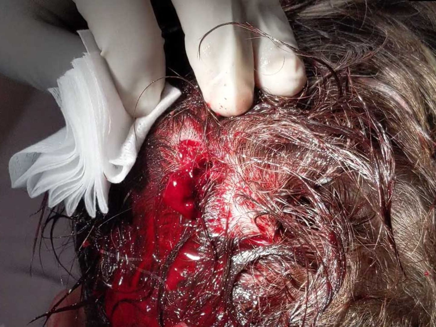 Sutured in Toronto, ON (June 28, 2025)