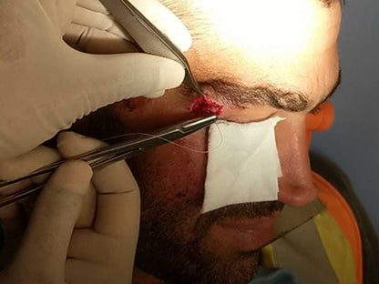 Sutured in Toronto, ON (June 28, 2025)