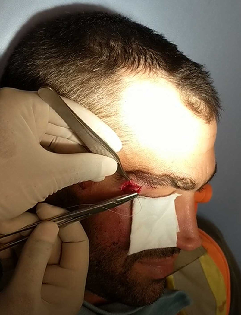 Sutured in Winnipeg, MB (November 19, 2022)